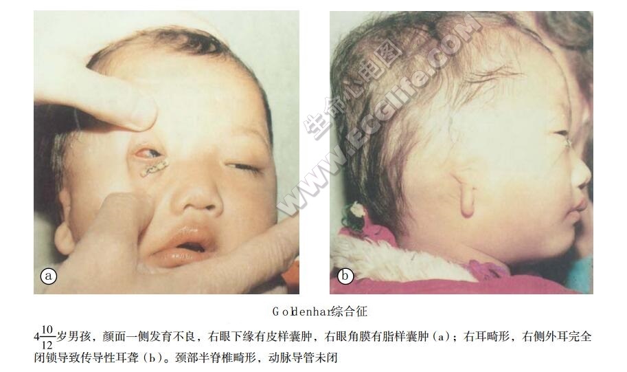 Goldenhar综合征（眼-耳-脊椎发育不良综合征）