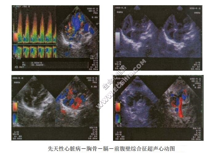 先天性心脏病-胸骨-膈-前腹壁综合征（Crillenden畸形）超声心动图