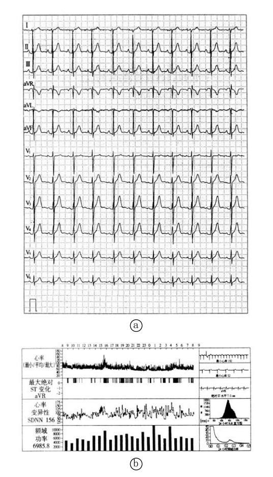 Longevity综合征（长寿综合征、家族性高脂蛋白血症）