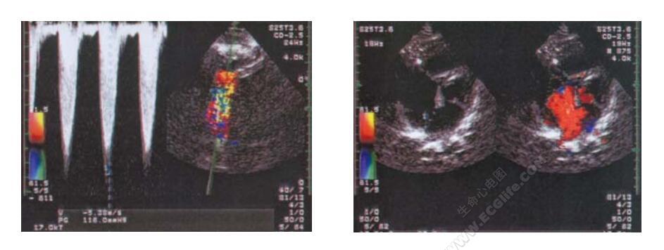 法洛综合征超声心动图