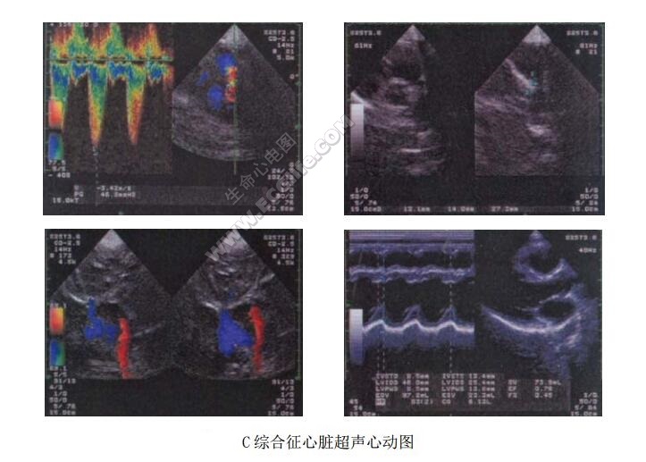 C综合征（Opitz三角头综合征）超声心动图