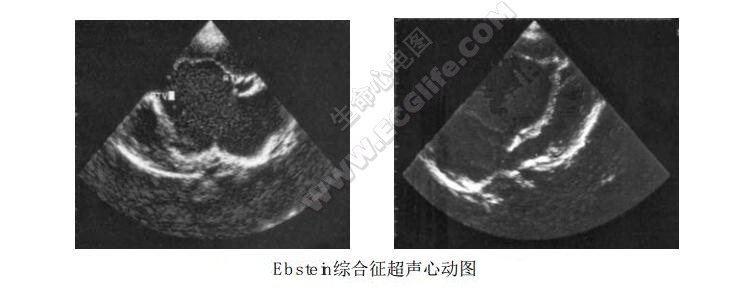 Ebstein综合征（三尖瓣下移畸形、爱勃斯坦畸形）超声心动图