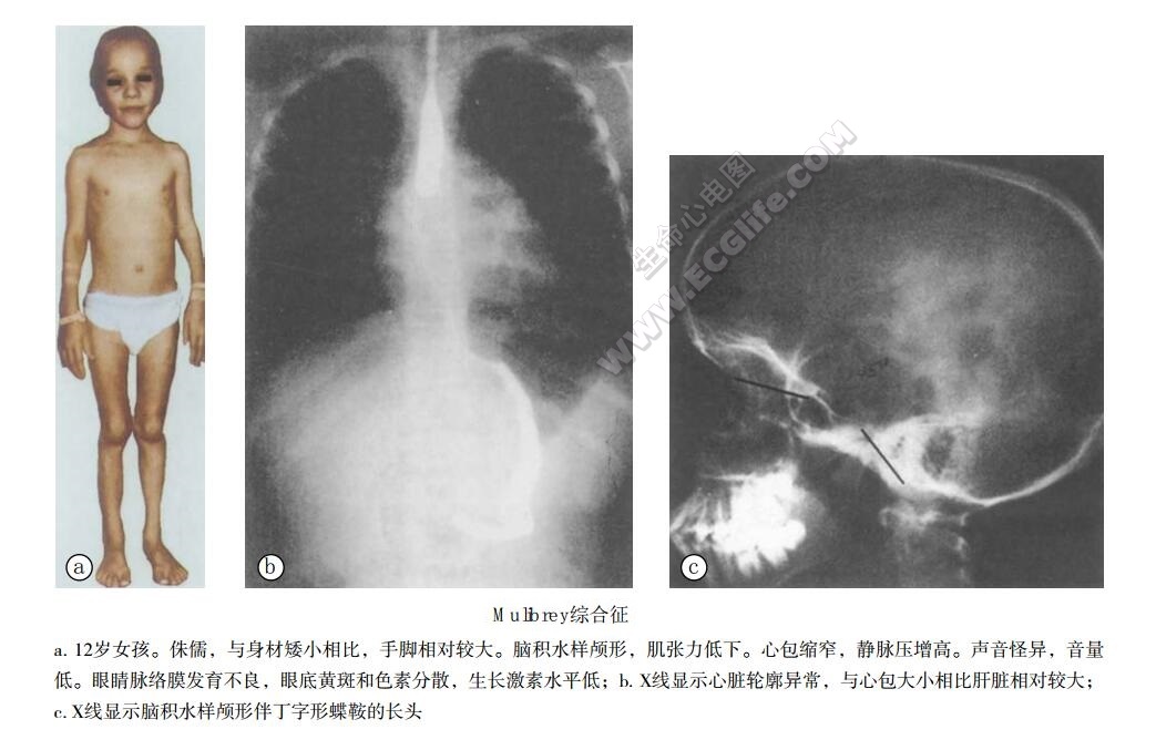 Mulibrey综合征（心包缩窄和生长停滞，肌、 肝、脑、眼侏儒症）患者表现