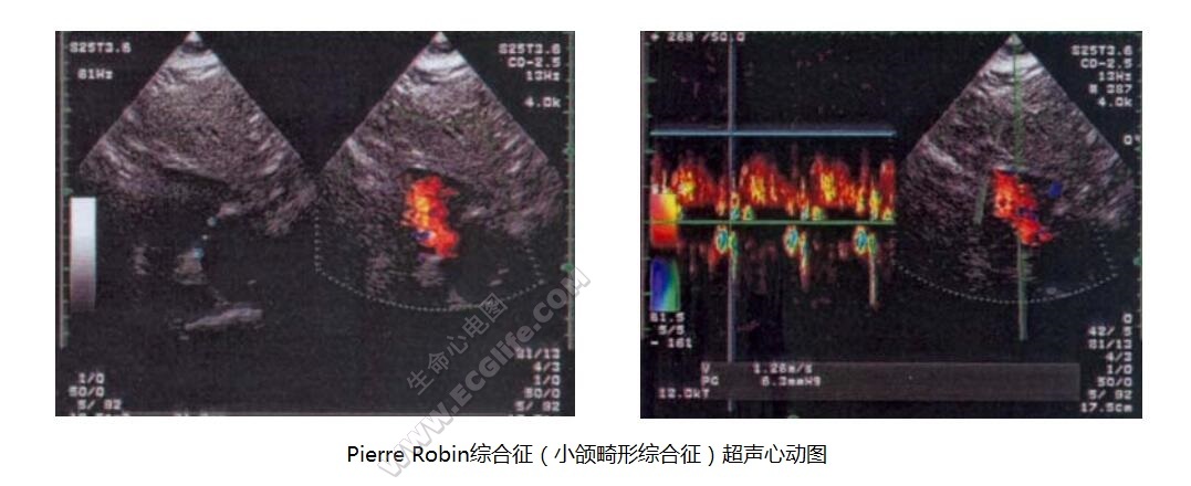 Pierre Robin综合征（小颌畸形综合征）超声心动图
