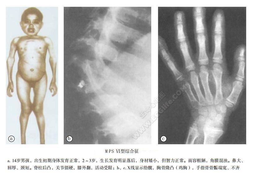 黏多糖Ⅴ型综合征（附：黏多糖贮积症各型特点表）