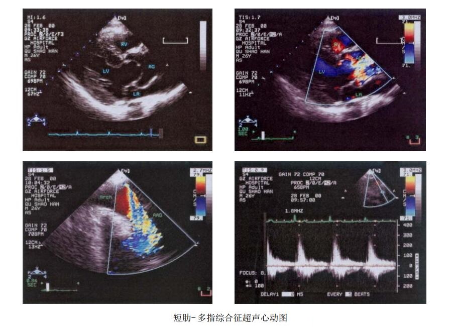 短肋-多指综合征超声心电图