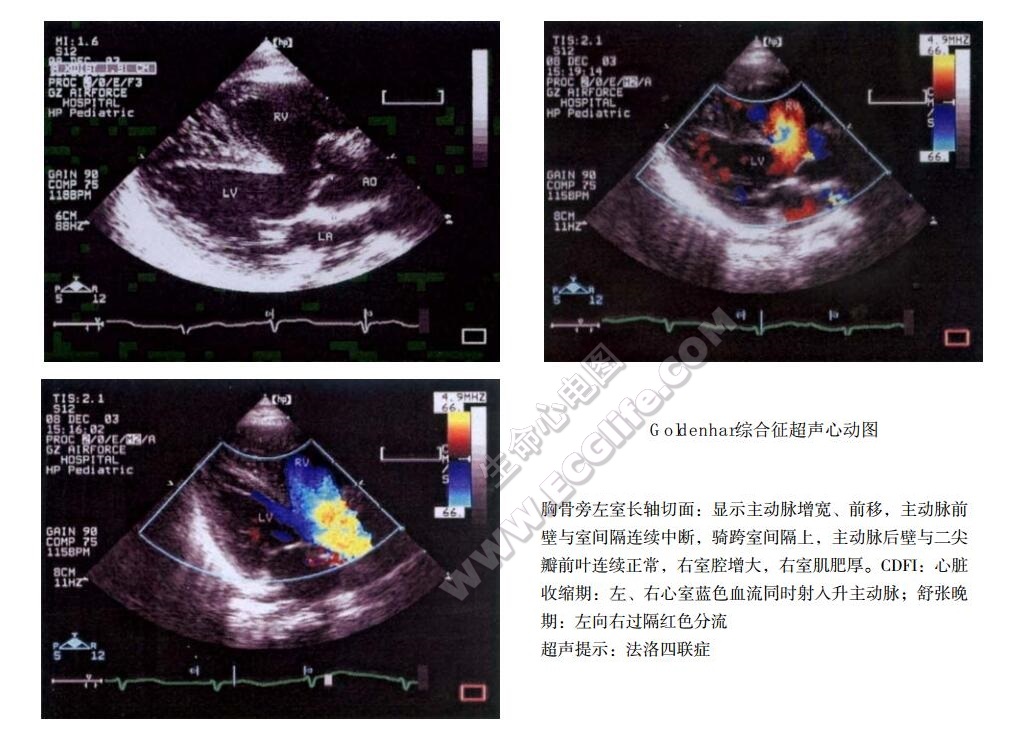 Goldenhar综合征（眼-耳-脊椎发育不良综合征）超声心电图