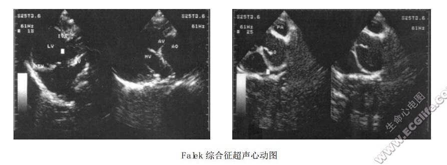 Falek综合征（肢-皮-心综合征、CHILD综合征）超声心动图