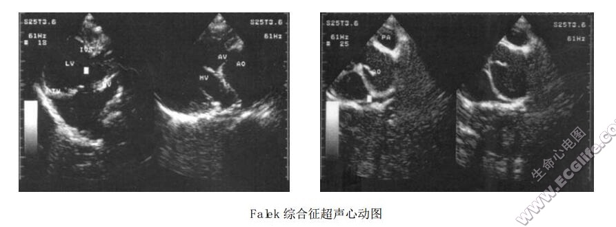 Falek综合征（肢-皮-心综合征、CHILD综合征）