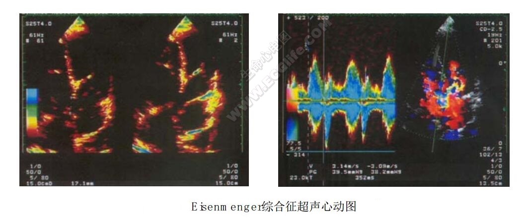 Eisenmenger综合征（艾森门格尔综合征）超神心动图