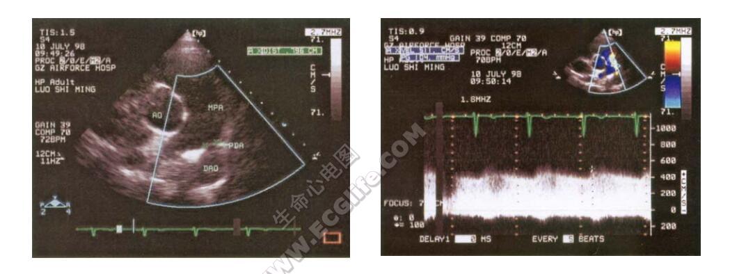 Guerin-Sterm综合征（先天性多发性关节挛缩、关节弯曲综合征）超声心动图