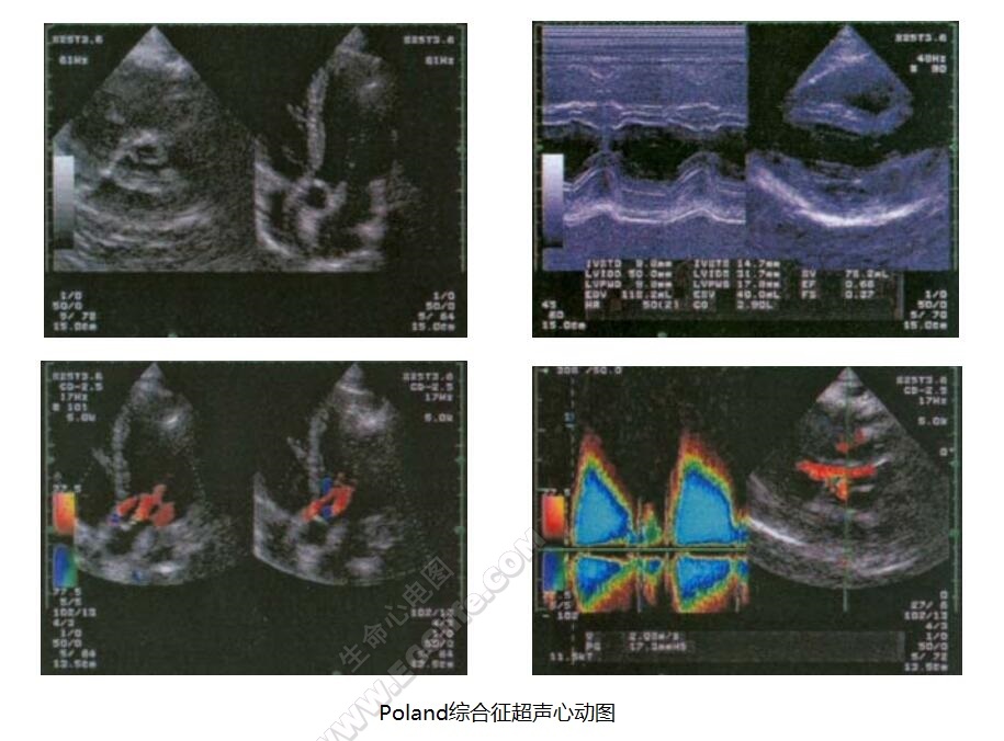 Poland综合征（波兰综合征、胸大肌缺损并指综合征）超声心动图检查