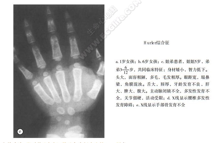 Hurler综合征（多发性骨发育不良综合征）患者X线片