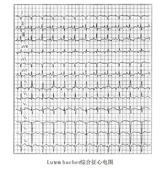 Lutembacher综合征（鲁登巴赫综合征）心电图表现