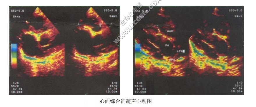 心面综合征（先天性嘴角降肌发育不良综合征）超声心动图