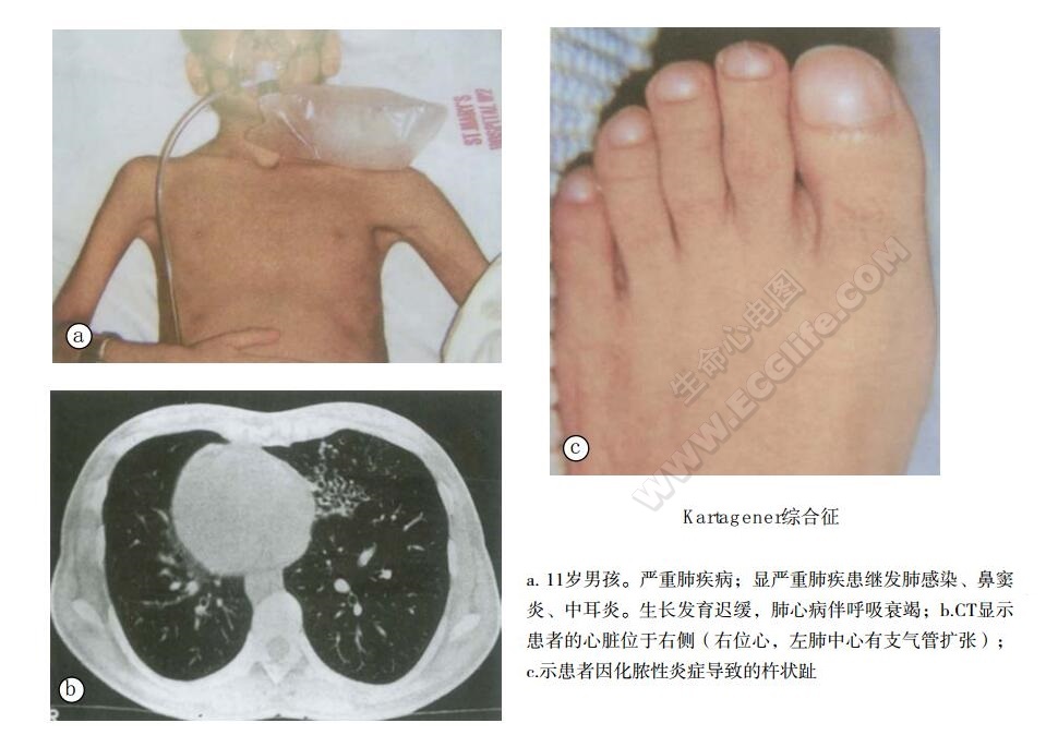 Kartagener综合征（副鼻窦-支气管扩张-内脏转位综合征）患者表现