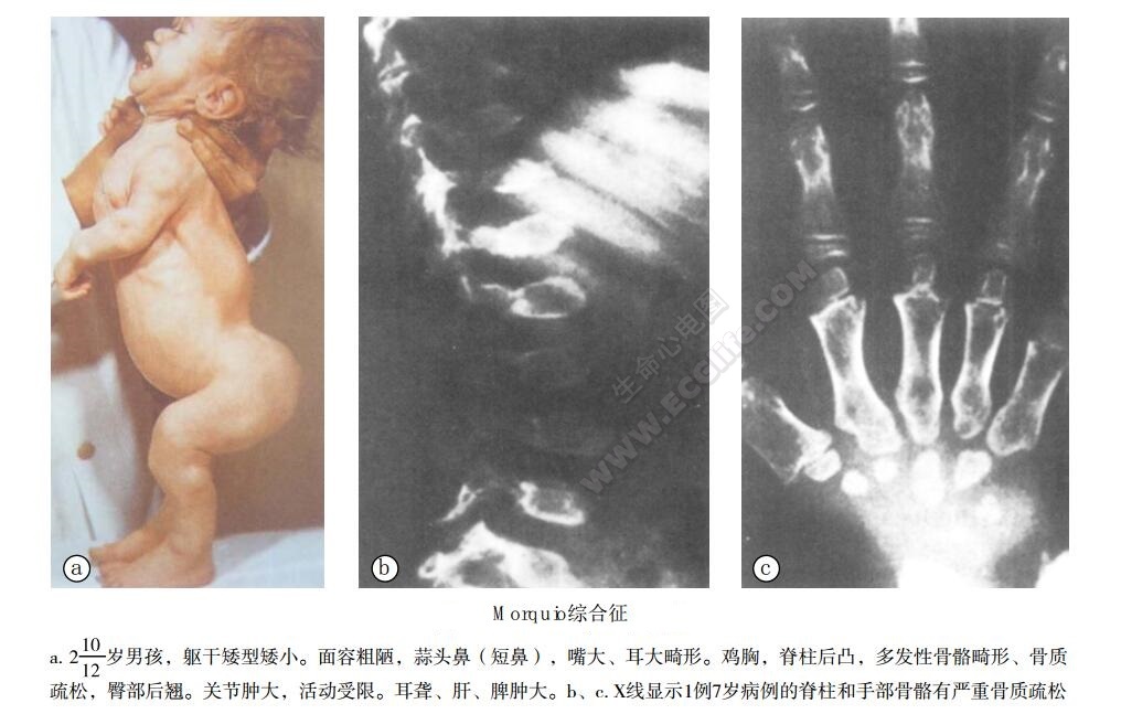 Morquio综合征（黏多糖病Ⅳ型综合征、硫酸角质素尿症）患者表现