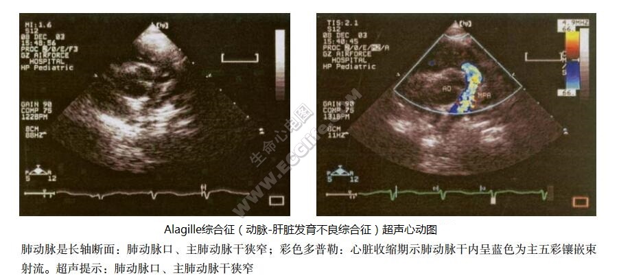 Alagille综合征（动脉-肝脏发育不良综合征）超声心动图表现