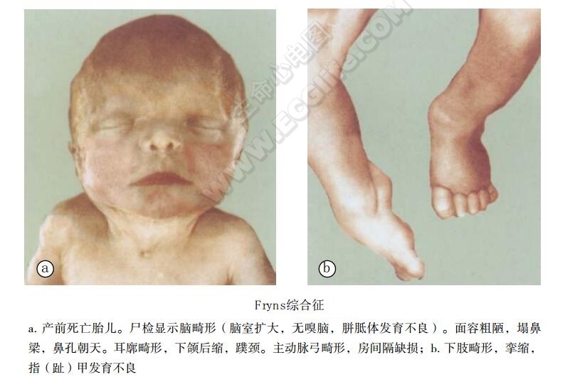 Fryns综合征（膈疝、异常面容和肢端异常）患儿表现