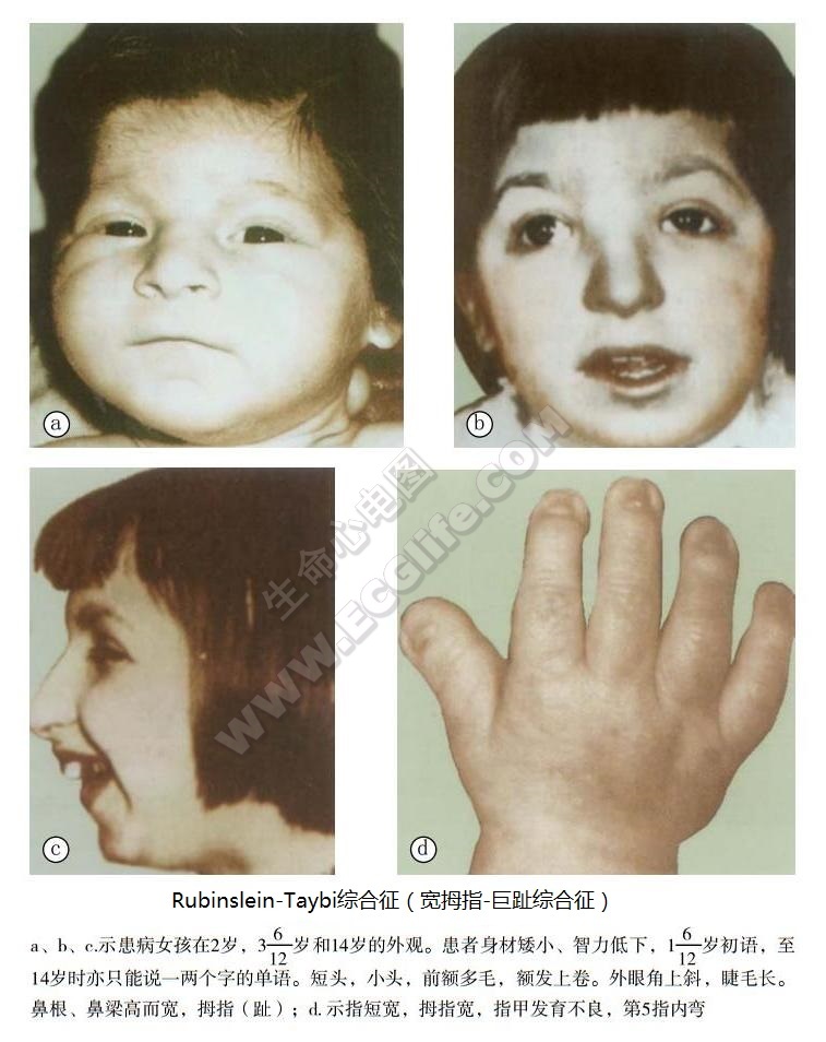 Rubinslein-Taybi综合征（宽拇指-巨趾综合征）