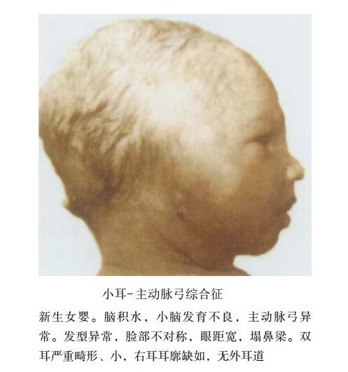 小耳-主动脉弓综合征（异维甲酸胚胎病样综合征）