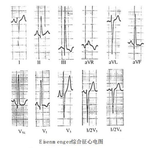 Eisenmenger综合征（艾森门格尔综合征）心电图表现