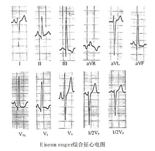 Eisenmenger综合征（肺动脉高压性右向左分流综合征）