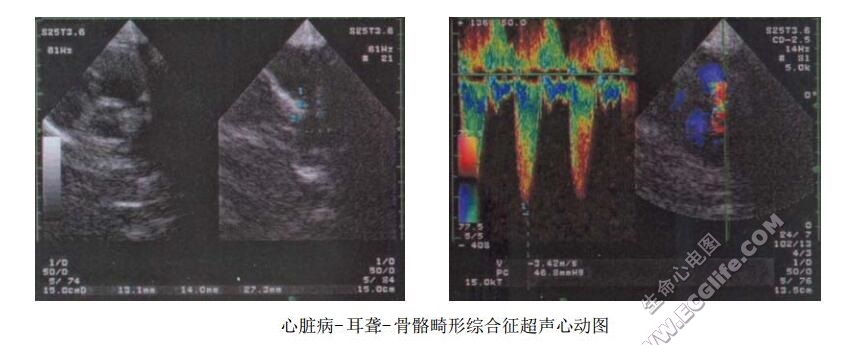 先天性心脏病-耳聋-骨骼畸形综合征超声心动图