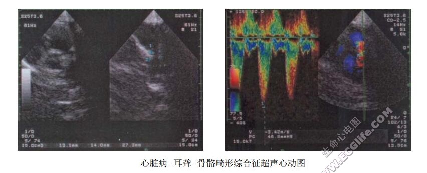 先天性心脏病-耳聋-骨骼畸形综合征