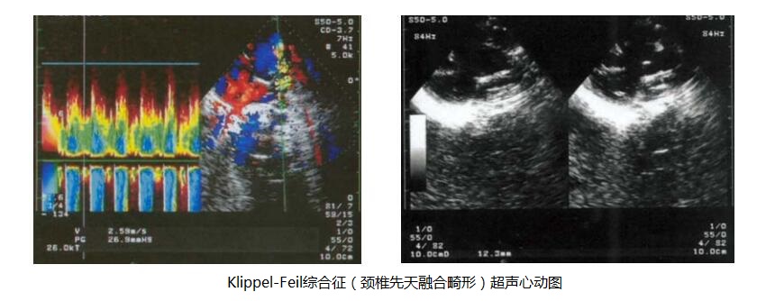 Klippel-Feil综合征（颈椎先天融合畸形）