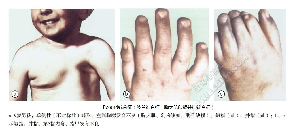 Poland综合征（波兰综合征、胸大肌缺损并指综合征）患儿胸部、手症状