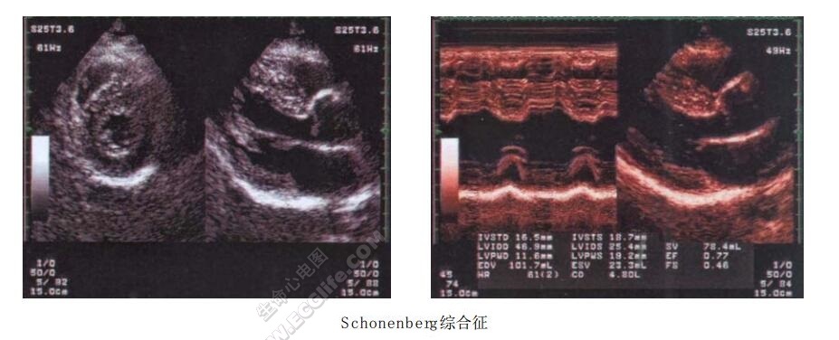 Schonenberg综合征（侏儒-心肌病综合征）