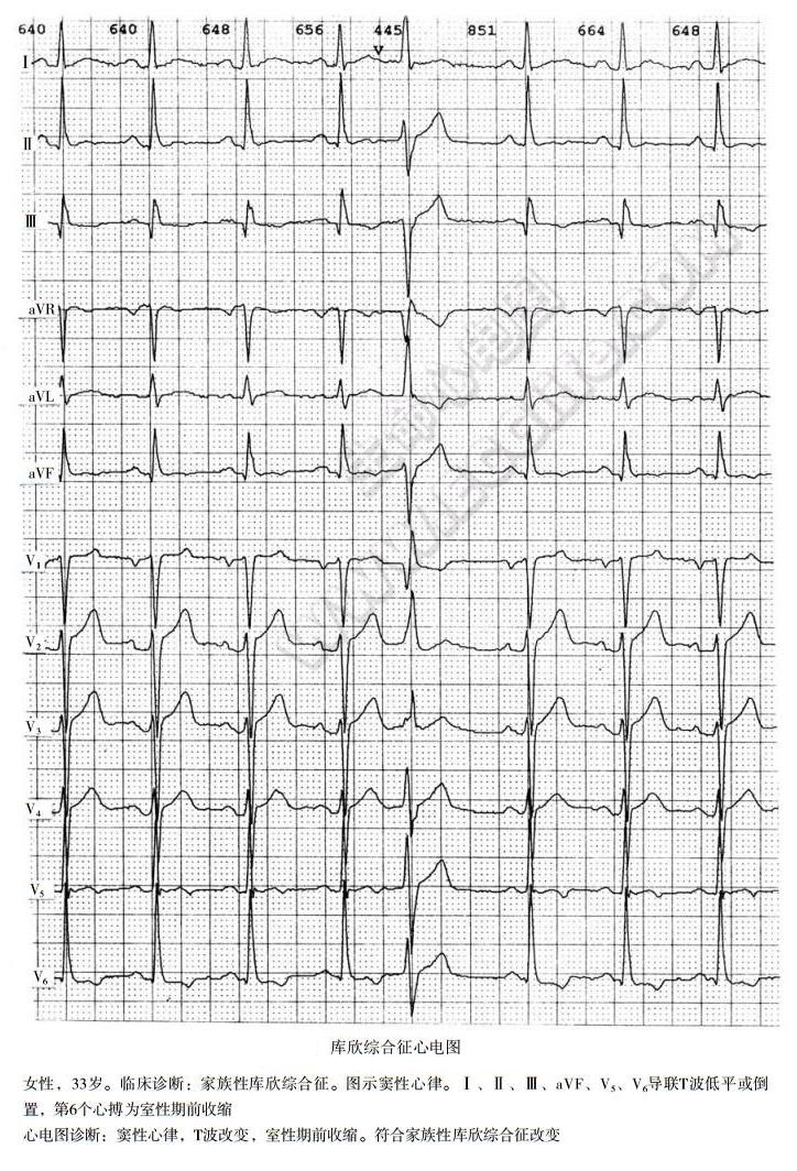 库欣综合征（遗传皮质醇增多症、先天肾上腺皮质增生）患者心电图表现