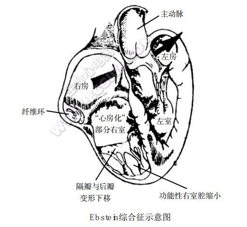 Ebstein综合征（三尖瓣下移畸形、爱勃斯坦畸形）