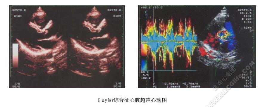 Cuyler综合征（先天性心脏病-面肌无力综合征）