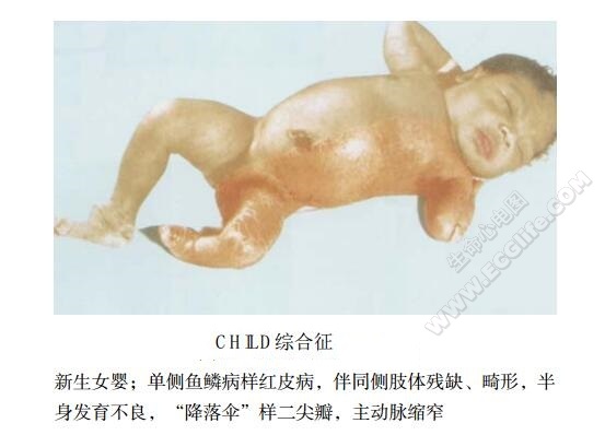 CHILD综合征（单侧鱼鳞癣样红皮病）患儿