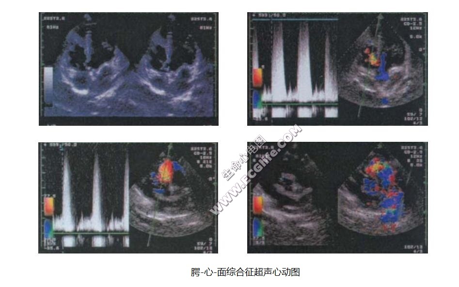 腭-心-面综合征（Shprintzen综合征）