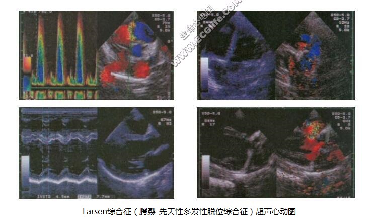 Larsen综合征（腭裂-先天性多发性脱位综合征）超声心动图