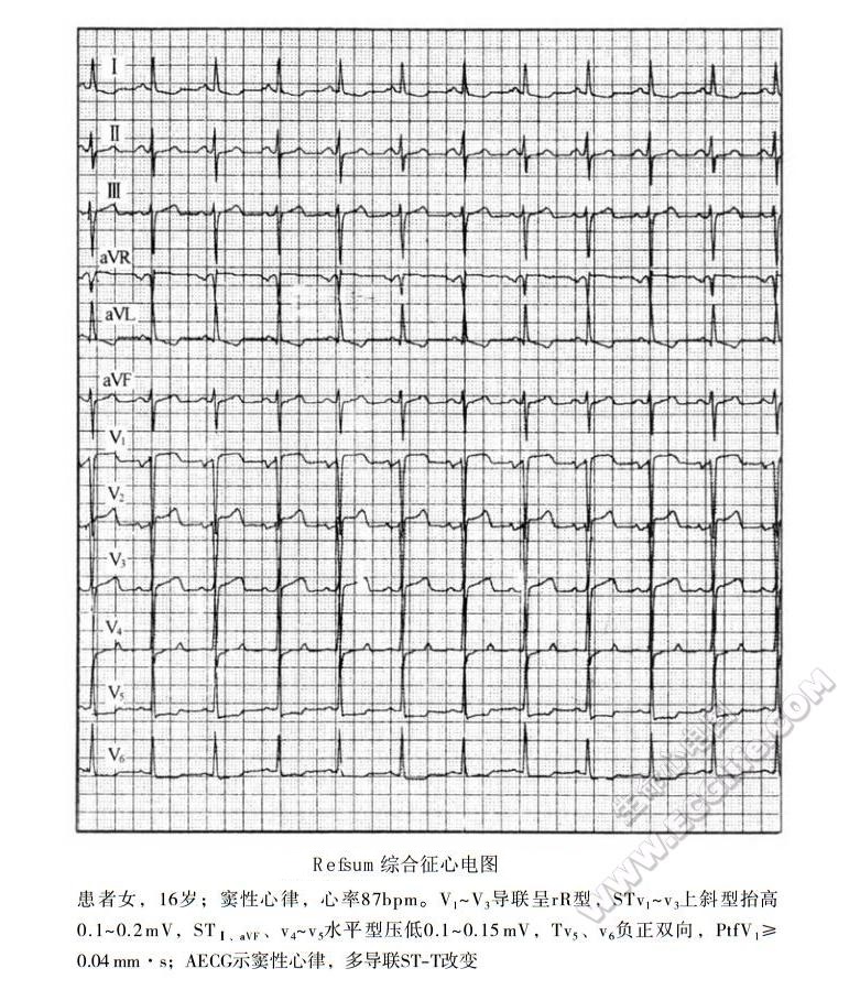 Refsum综合征（雷夫叙姆病、济失调-多发性神经炎综合征）心电图表现