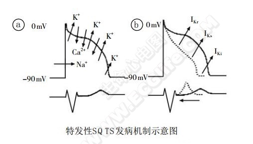 特发性SQTS发病机制示意图