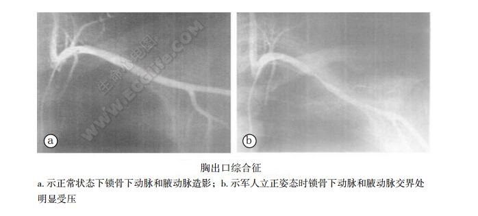 胸出口综合征（前斜角肌综合征、Naffziger氏综合征）