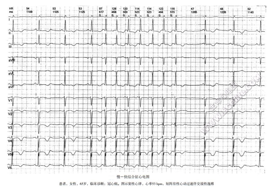 快-慢综合征心电图表现