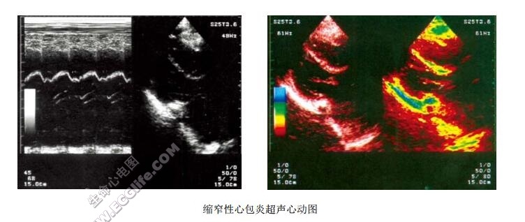 缩窄性心包炎超声心动图