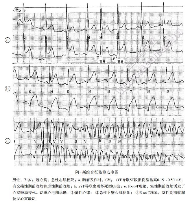 阿-斯综合征（急性心源性脑缺氧综合征）检测心电图