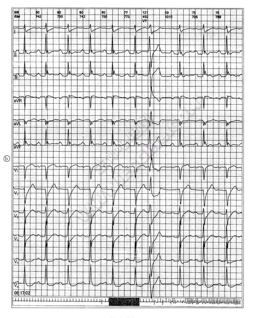J波综合征致心脏性猝死动态心电图2