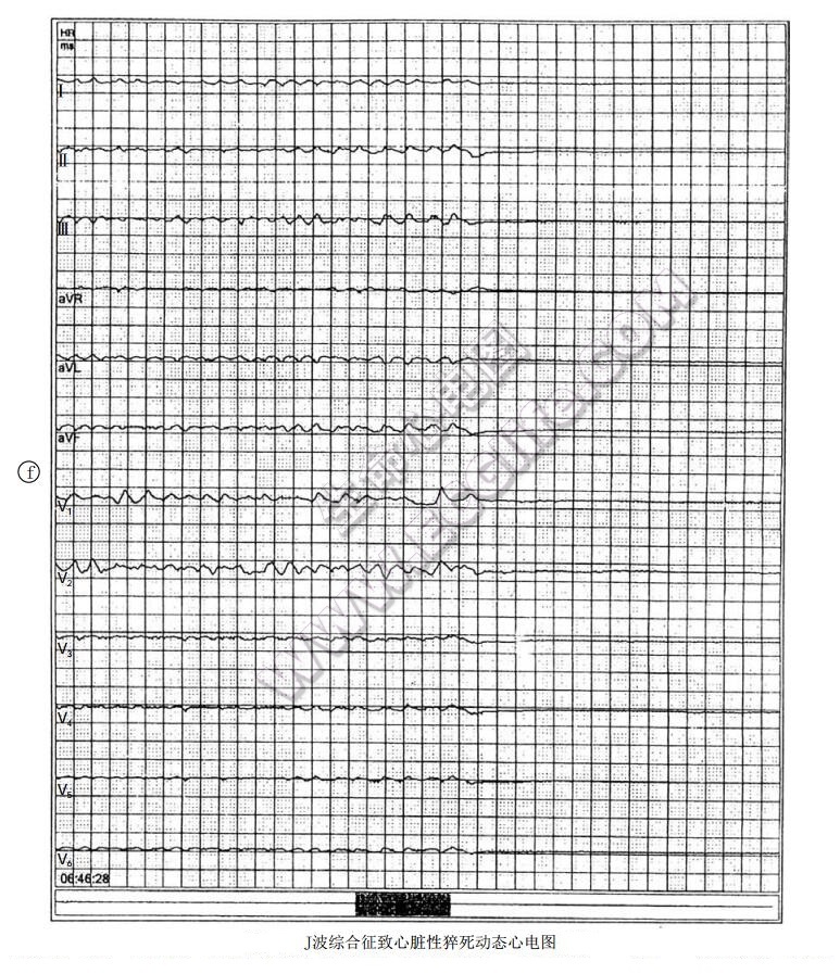 J波综合征致心脏性猝死动态心电图6