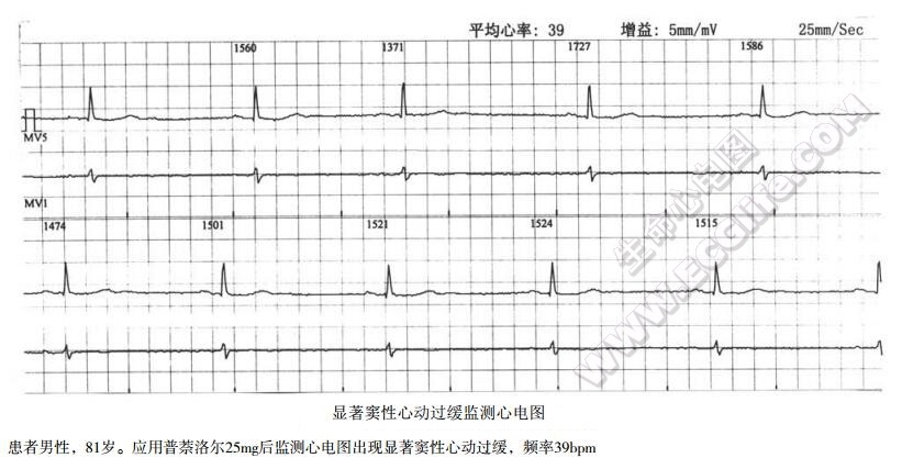 β受体阻滞剂首剂综合征（心得安类首剂综合征）