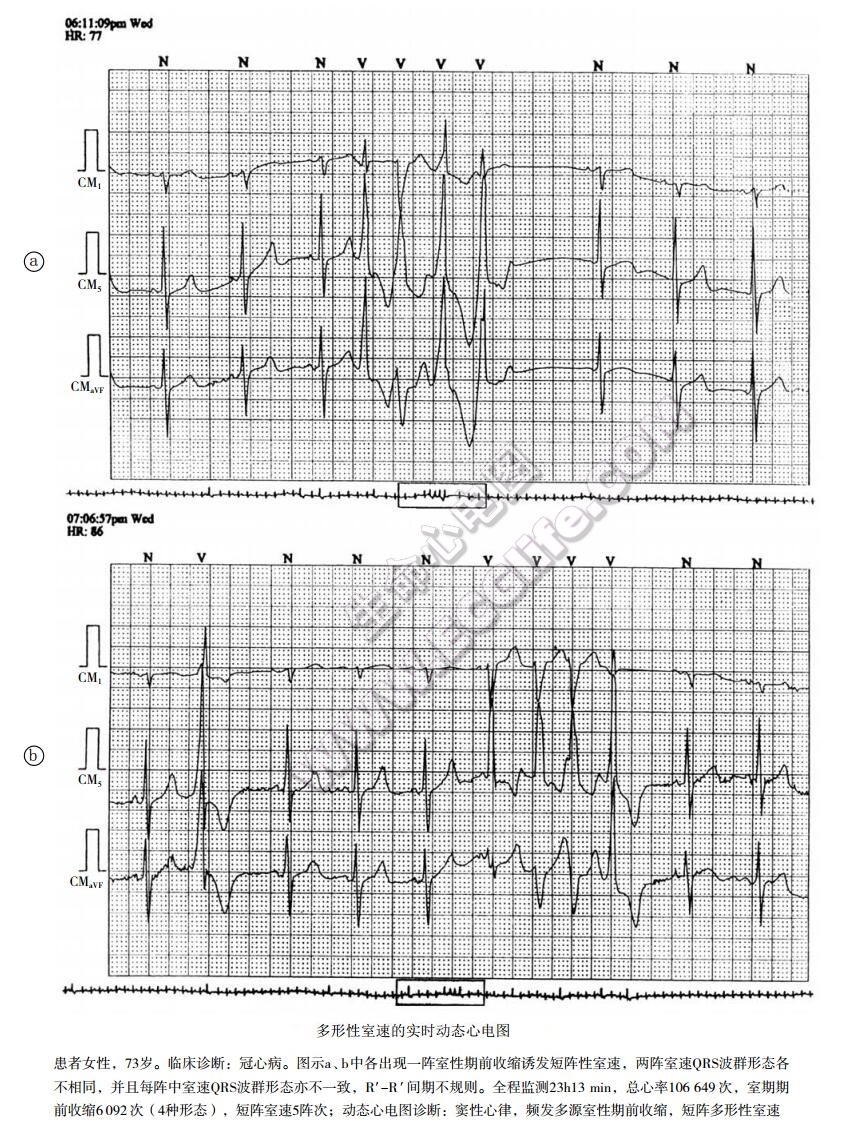 多形性室速的实时动态心电图