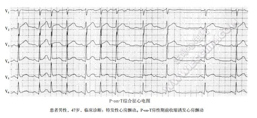 P-on-T综合征心电图表现