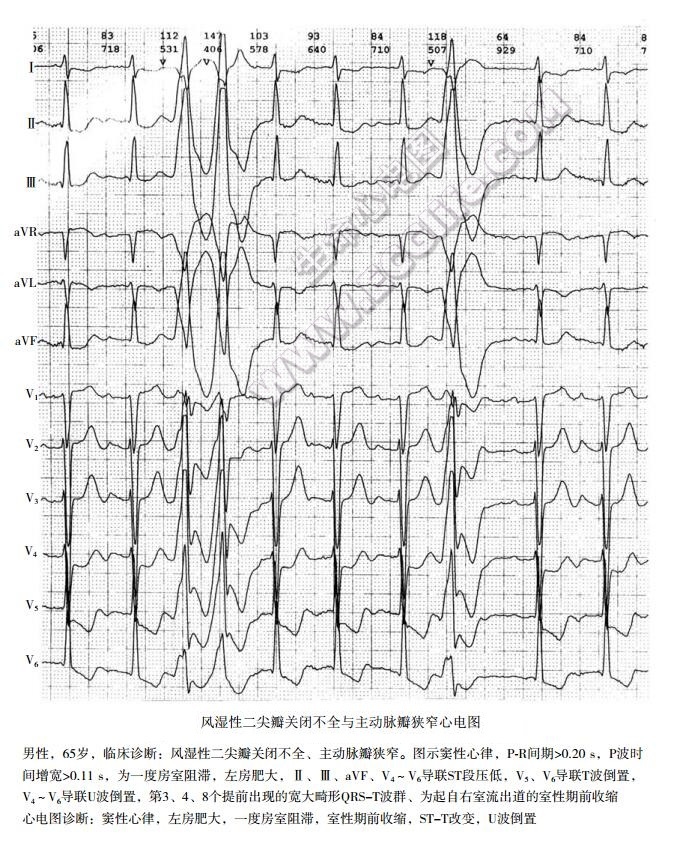风湿性二尖瓣关闭不全与主动脉瓣狭窄心电图